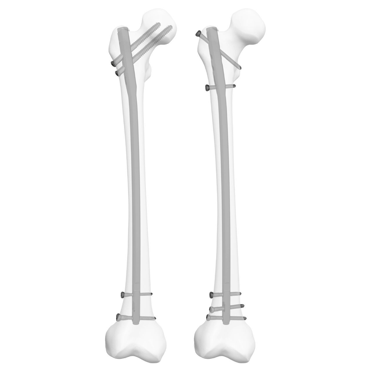 Интрамедуллярный штифт бедренная кость - 305009 - Boneunion Medical ...