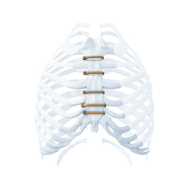 Ортопедическая проволока для закрытия груди - ZIPFIX™ - Depuy Synthes ...