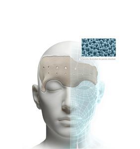 имплантат изготовленный методом 3D-печати