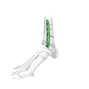 костная пластина для артродеза для щиколотки
