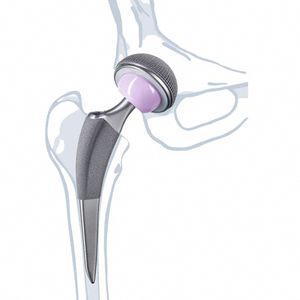протез бедра для первичного эндопротезирования