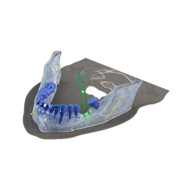 Программное обеспечение для стоматологической имплантологии - Reconstruction 3D - Drive Dental Implants - для моделирования зубного импланта / для визуализации 3D / для моделирования