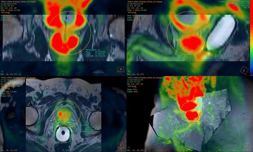 Программное обеспечение для анализа - Fusion Technology™ - Hermes Medical Solutions, Inc - для визуализации 3D / для составления отчетности / с системой отслеживания