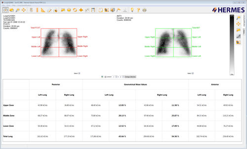 Программное обеспечение для анализа - Lung Lobe Quantification™ - Hermes Medical Solutions, Inc - для диагностики / для планирования / для оценки