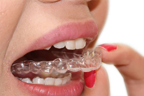 Элайнер - Smilers  - BIOTECH DENTAL