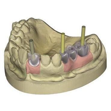 Модуль программного обеспечения для стоматологической имплантологии - 4207 - Champions Implants GmbH - для разработки / CAO