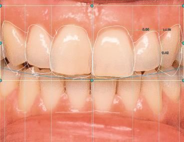 Модуль программного обеспечения для стоматологии - 4218U - Champions Implants GmbH - CAO / для создания цифровой улыбки / FAO