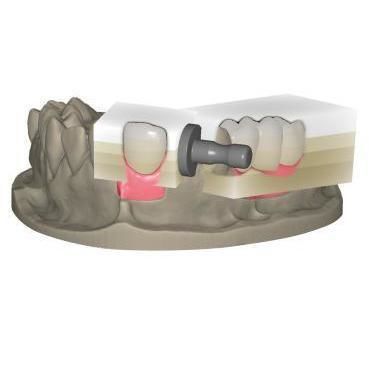 Модуль программного обеспечения для восстановления зубов - In-Cad Nesting - Champions Implants GmbH - для разработки / для производственного процесса / зубов