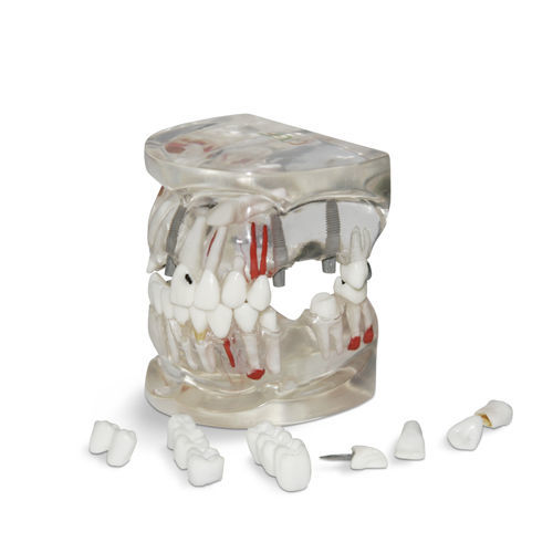 Анатомическая модель нерва - T04 - GF DENTAL - челюсть / зубов / для имплантологии