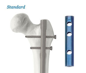 Интрамедуллярный штифт бедренная кость - AOS - Advanced Orthopaedic Solutions