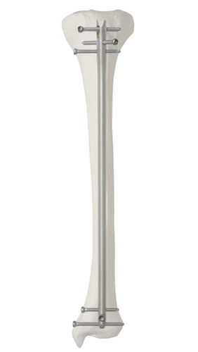 Интрамедуллярный штифт большеберцовая кость - Da Vinci™ - AOS - Advanced Orthopaedic Solutions - проксимальная фиксация / дистальная фиксация