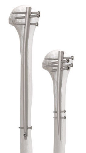 Интрамедуллярный штифт плечевая кость - Newton™ - AOS - Advanced Orthopaedic Solutions - проксимальная фиксация