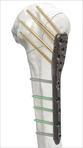 Компрессионная костная пластина плечевая кость - AOS - Advanced Orthopaedic Solutions - проксимальная / блокируемая / металлическая
