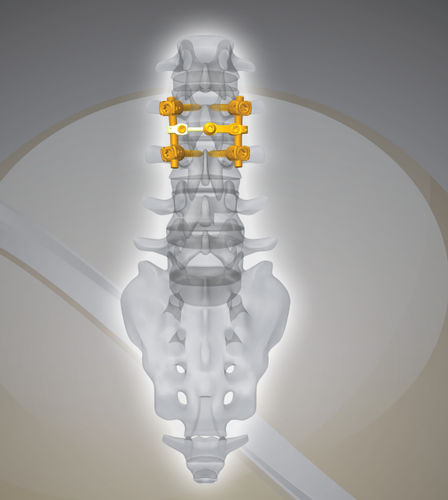 Система остеосинтеза для поясничной зоны - NEX D2 - Next Orthosurgical - через задний отдел