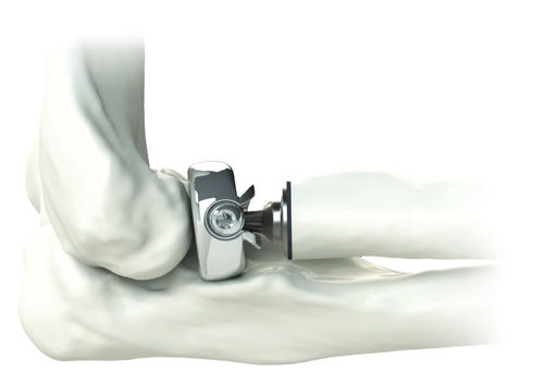 Протез суставной головки лучевой кости - ALIGN ® - Skeletal Dynamics
