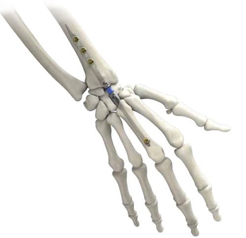 Интрамедуллярный штифт для запястья - IMPLATE ® - Skeletal Dynamics