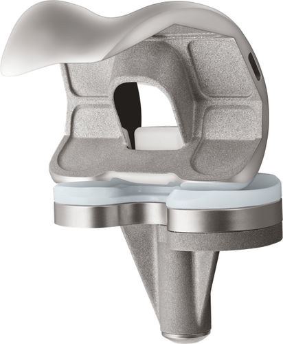Коленный протез с 3 отсеками - U2™  - US Orthopedics - с фиксированным вкладышем