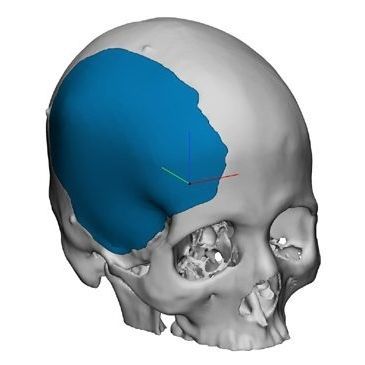 Черепной имплантат на заказ - OP89020 - Matrix Surgical USA
