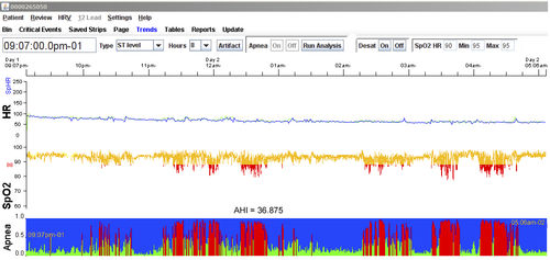 Испытательное программное обеспечение - LX Sleep - NorthEast Monitoring - для регистрации / для анализа / для полисомнографии
