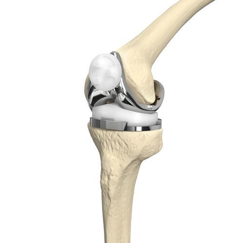 Коленный протез с 3 отсеками - Canwell Medical