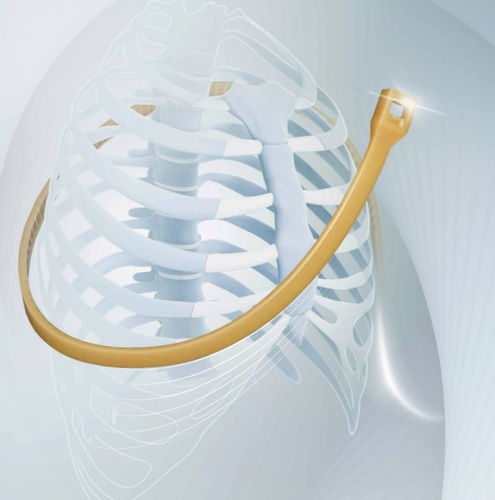 Ортопедическая проволока для закрытия груди - SternoEaZip® - Kontour Medical Technology - полимерный монофиламент
