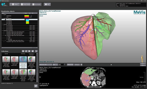 Медицинское программное обеспечение - MeVis  - VAREX Imaging - TDM / для МРТ / для системы архивации и передачи изображений