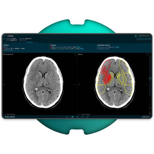 Программное обеспечение для диагностики инсульта - e-Stroke - Brainomix - медицинское / TDM / для анализа изображений