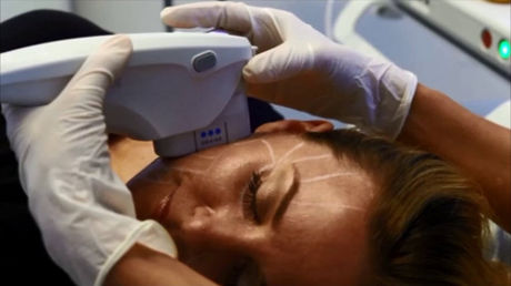 Аппарат для ультразвукового пилинга - Ultherapy® - Merz Pharma - аппарат HIFU для контурной пластики тела / на тележке
