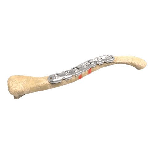 Компрессионная костная пластина для ключицы - 00-1005-5006 - OrthoPediatrics - медиальная / блокируемая / металлическая