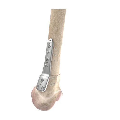 Костная пластина для остеотомии бедренная кость - 00-1050-5104 - OrthoPediatrics - дистальная / блокируемая / металлическая