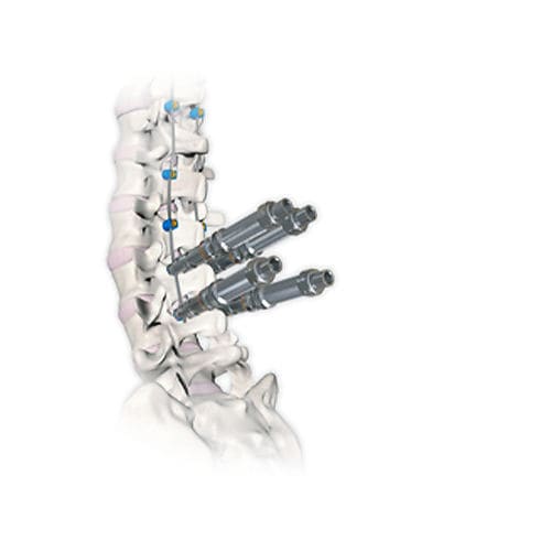 Система остеосинтеза для грудо-поясничной зоны - RESPONSE™ 4.5/5.0 - OrthoPediatrics - через задний отдел / педиатрическая