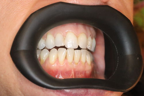 Расширитель губы - VisionButler™ - Gate Dental Services Ltd - для щек / для стоматологии / стерилизуемый в автоклаве