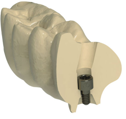 Стоматологический материал для восстановления зубов - G-DAS - Dynamic Abutment Solutions - CFAO / для фрезерования / высоко транслюцентный