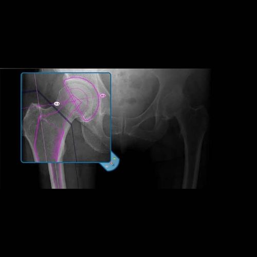 Медицинское программное обеспечение - OrthoView - Materialise UK - для анализа / для управления / для планирования