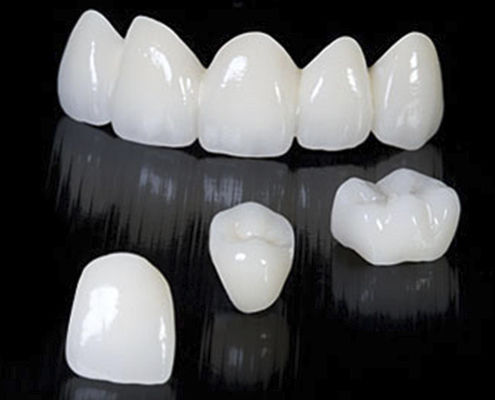 Циркониевый зубной мост - CRYSTAL - Derby Dental - для передних зубов