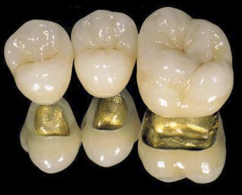 Зубная коронка из PFM - CLASSIC  - Derby Dental - для передних зубов / для задних зубов