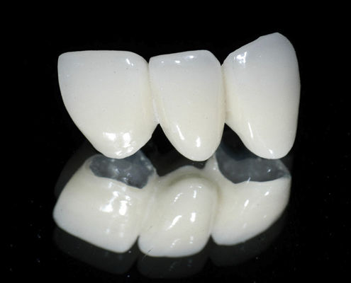 Зубной мост из PFM - CLASSIC  - Derby Dental - для передних зубов / для задних зубов