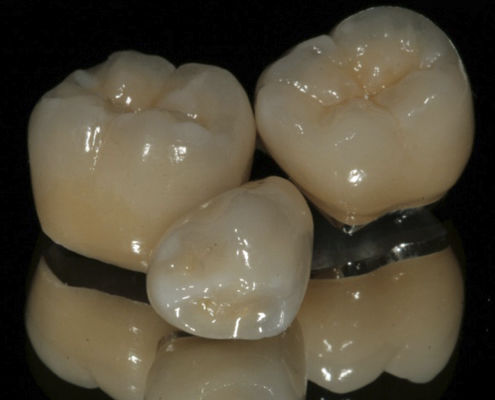 Зубная коронка из PFM - ECONOMY  - Derby Dental - для передних зубов / для задних зубов