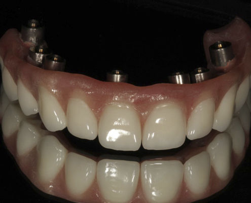 Стоматологический протез из акрила - Screw Retained  - Derby Dental - для передних зубов / для задних зубов