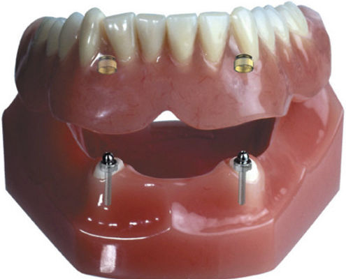 Стоматологический протез для передних зубов - Attachment Retained  - Derby Dental - для задних зубов