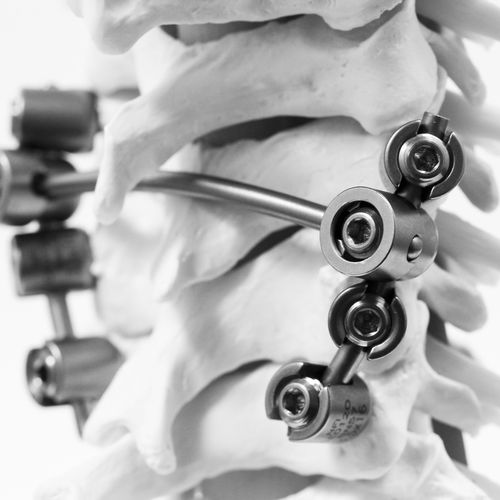 Система остеосинтеза шеи - KM BEBE - NEURO FRANCE Implants - через задний отдел / педиатрическая