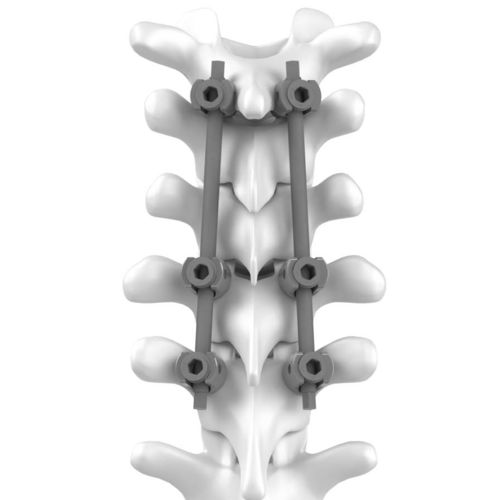 Шейно-грудная система остеосинтеза - C.T.J - NEURO FRANCE Implants - через задний отдел