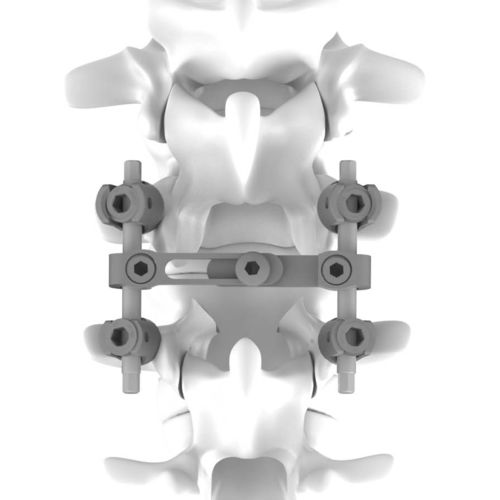 Система остеосинтеза для грудо-поясничной зоны - K.M. - NEURO FRANCE Implants - через задний отдел
