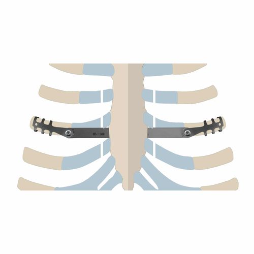 Компрессионная костная пластина для ребер - ThoRib® PECTUS - NEURO FRANCE Implants - из титана / педиатрическая