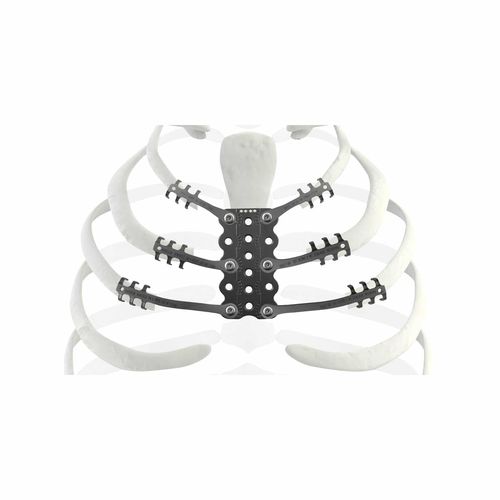Грудной протез для восстановления после резекции остеосаркомы - TRIONYX® - NEURO FRANCE Implants