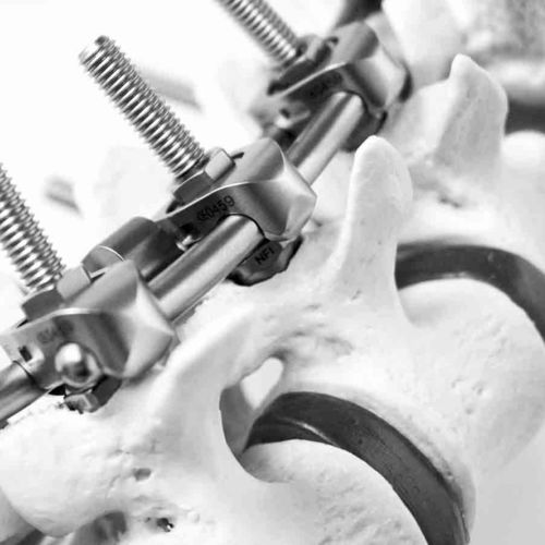 Система остеосинтеза для грудо-поясничной зоны - S.E.S+ - NEURO FRANCE Implants - через задний отдел