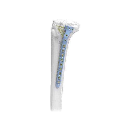 Компрессионная костная пластина большеберцовая кость - PNM1054-TP2 - NORMMED Medical Devices - проксимальная / медиальная / блокируемая