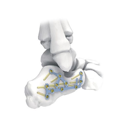 Компрессионная костная пластина для пяточной кости - PNM1032 - NORMMED Medical Devices - блокируемая / металлическая