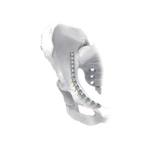 Компрессионная костная пластина таз - J - NORMMED Medical Devices - блокируемая / металлическая
