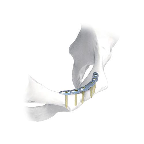 Компрессионная костная пластина таз - NORMMED Medical Devices - блокируемая / металлическая